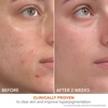 image:imageDr Dennis Gross Alpha Beta 2 BHA Breakout Solution Minimizes Pores Clear amp Prevent Breakouts 5 Fl Oz