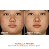 image:imageDr Dennis Gross Alpha Beta 2 BHA Breakout Solution Minimizes Pores Clear amp Prevent Breakouts 5 Fl Oz